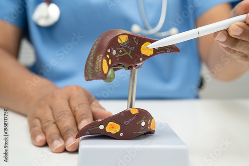 Cirrhosis, Liver cancer, fatty liver, Asian doctor with liver human anatomy model in World Hepatitis Day at hospital.