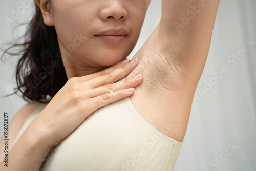 Asian woman have problem black armpit beauty skin care.