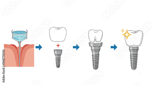 Four step diagram showing the dental implant procedure from a damaged root to a complete new shiny tooth crown.