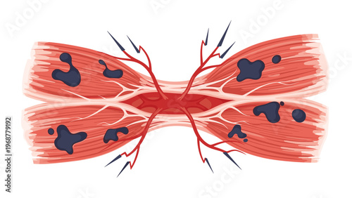 Anatomical illustration of human muscle fibers with visible blood vessels and dark lesions representing injury.