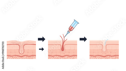 Medical diagram showing the process of injecting a treatment into a hair follicle to stimulate growth or treat scalp conditions for hair care.
