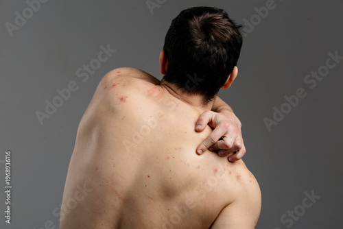 Konstfotografi The young man's back is covered with pimples and signs of inflammation