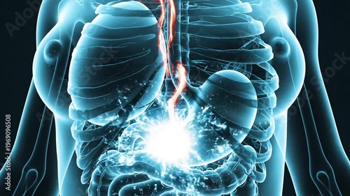Medical Animation Showing Human Digestive System and the Progression of Acid Reflux Disease