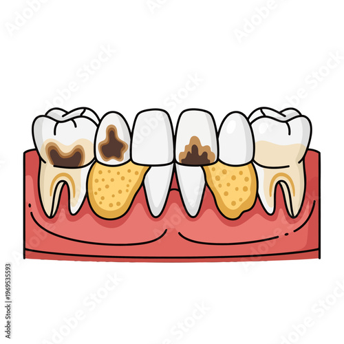 Unhealthy teeth showing decay and plaque buildup on gums