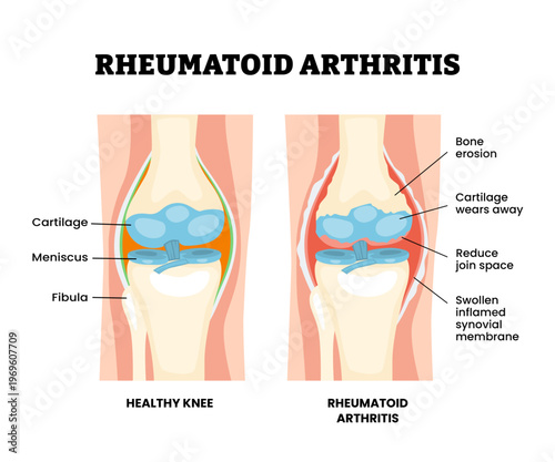 Rheumatoid arthritis knee injury. Labeled bone erosion, reduce joint space, swollen inflamed synovial membrane, meniscus. Synovial joint anatomy. Frontal view human knee joint. Vector illustration.
