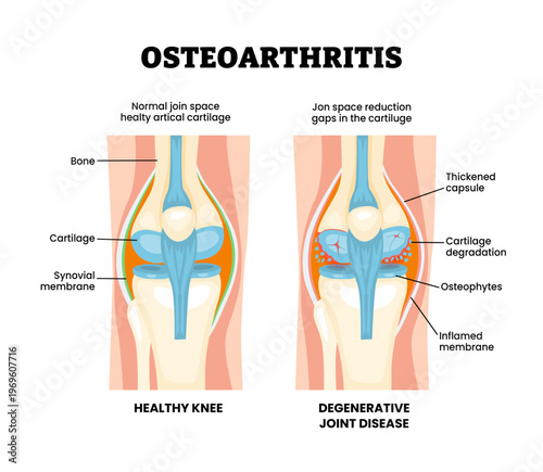 Osteoarthritis knee injury. Labeled swelling and inflammation synovial. Synovial membrane. xxx. joint anatomy. Frontal view of human knee joint. Vector illustration.