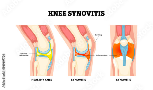 Knee synovitis knee injury. Labeled swelling and inflamed synovial membrane, excess synovial fluid, joint effusion. Synovial joint anatomy. Frontal side view of human knee joint. Vector illustration.