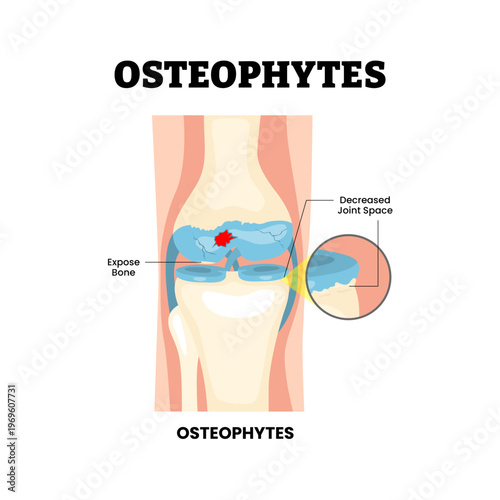 Osteophytes knee injury. Labeled exposed bone, decreased joint space. Degenerative cartilage wear and synovial inflammation. Synovial joint anatomy. Frontal view human knee joint. Vector illustration.