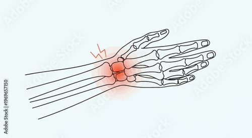 Hand Wrist Pain Illustration - Carpal Tunnel Syndrome, Arthritis, Injury