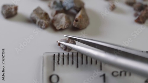 Fragments of a kidney stone crushed by ultrasound with a diameter of 1.5 centimeters