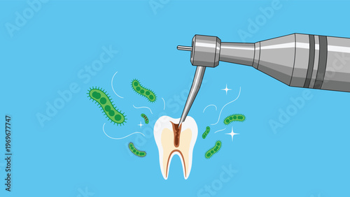 Medical illustration showing a dental drill treating a decayed tooth with visible root canals and green bacteria floating in the air around.