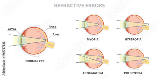 Human eye anatomy poster. Refractive errors of vision, hyperopia, myopia, astigmatism, presbyopia. Flat vector illustration.