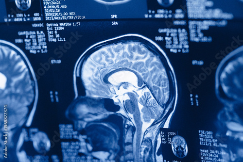 Bild auf Leinwand Brain scan showing detailed structures and measurements from a medical imaging p