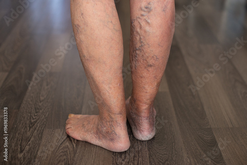 Foto Patient showing severe varicose veins on legs