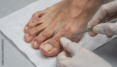 Foot care: Professional examines diseased toenails with specialized tool