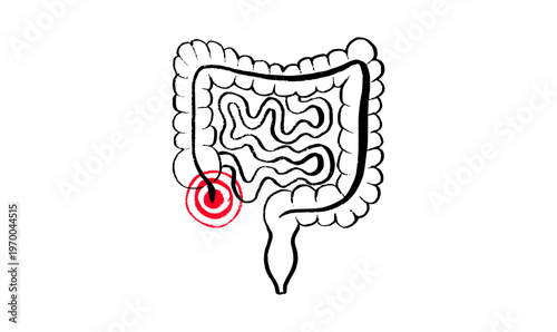 Inflamed appendix scetch