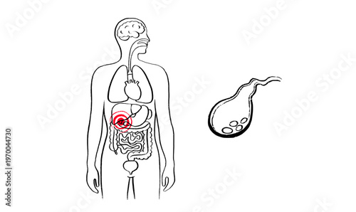 Human Gallbladder Disease