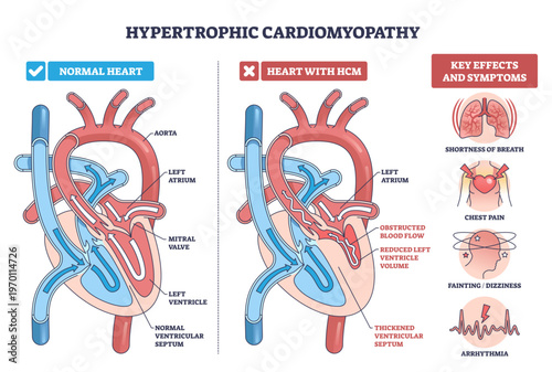 Hypertrophic cardiomyopathy diagram compares normal and HCM hearts, showing thickened septum, mitral valve obstruction, and reduced blood flow, key symptoms shown, transparent background.