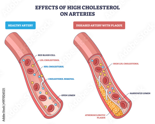 High cholesterol effects on arteries shown by plaque buildup narrowing the lumen, key elements are artery wall, atherosclerotic plaque, red blood cells, transparent background.