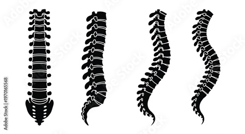Four spinal columns displaying varying degrees of curvature silhouette