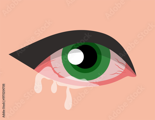 Allergic conjunctivitis illustration. Hand-drawn vector clip art.