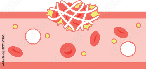 出血時の血管の断面　フィブリン血栓