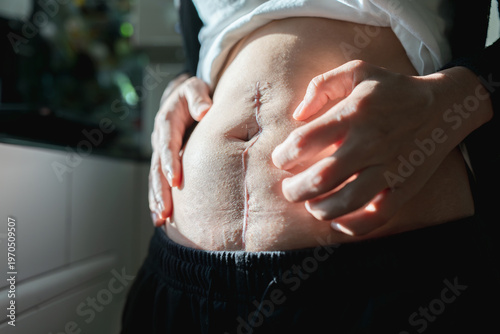 Принти на полотні Close-up of a person scratching an itching surgical scar on the abdomen, showing healing from intestinal obstruction surgery