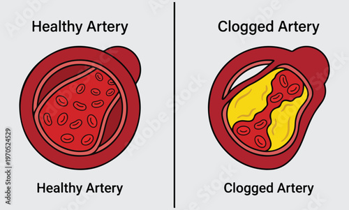Medical Illustration Comparing a Healthy Artery with a Clogged Artery Showing Plaque Buildup and Atherosclerosis