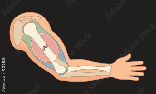 Medical Illustration of a Broken Humerus Bone in a Human Arm Showing a Fracture, Orthopedic Injury Diagram for Health and Anatomy Education.