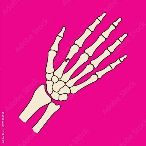 Vector Illustration of a Human Hand Skeleton with a Broken Metacarpal Bone, Medical Anatomy and Bone Fracture Concept.