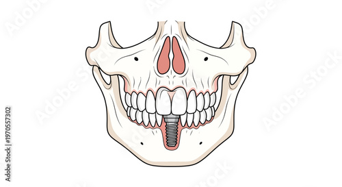 Detailed Dental Implant in Human Jaw Vector Illustration Depicting Tooth Replacement and Oral Surgery Procedure for Educational and Healthcare Niche