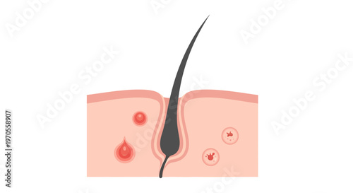 Detailed Human Skin Cross-Section with Inflamed Hair Follicle and Acne Pustules Vector Illustration for Dermatology, Health, and Beauty Education.