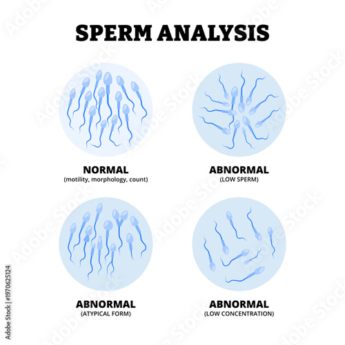 Different types of sperm analysis types. Labeled normal motility morphology count, abnormal low sperm, atypical form, low concentration. Male fertility test. fertility treatment. Vector illustration.