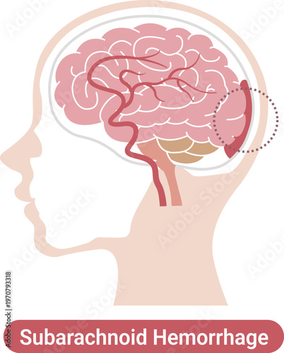 Subarachnoid hemorrhage medical illustration brain bleeding diagram(English Labels)	

