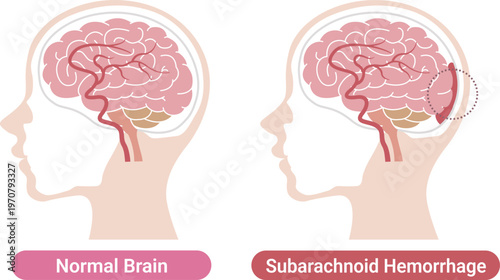 Subarachnoid hemorrhage comparison with normal brain medical illustration(English Labels)	
