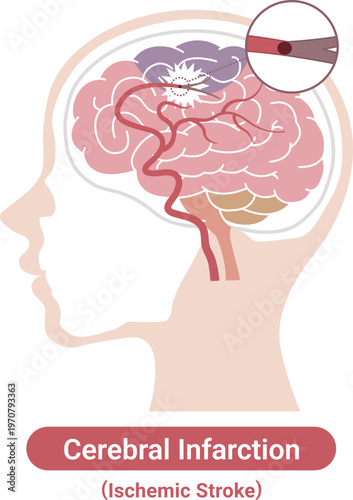 Ischemic stroke brain infarction medical illustration(English Labels)	
