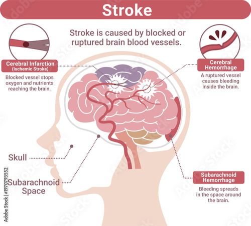 Stroke Types Medical Illustration(English Labels)	