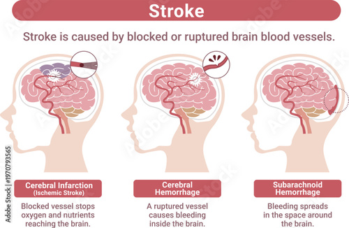 Stroke types medical infographic brain infarction cerebral hemorrhage subarachnoid hemorrhage explanation(English Labels)