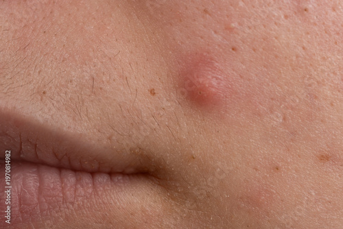 Pimple on skin with pores and sebum. Acne with inflamed follicles and epidermis texture. Skincare concept for acne and irritated pores. Detail of pimple with inflammation and blemish.