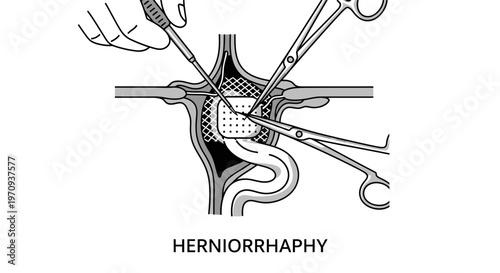 Herniorrhaphy Surgical Procedure Illustration with Mesh Implantation.