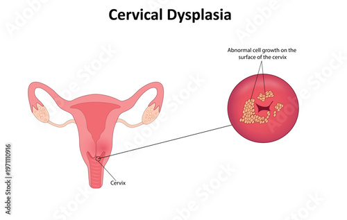 Cervical dysplasia vector illustration