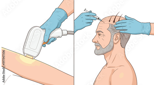 Hair Transplant Procedure and Laser Hair Removal Vector Illustration with Medical Treatment, Dermatology and Cosmetic Surgery Concept Design