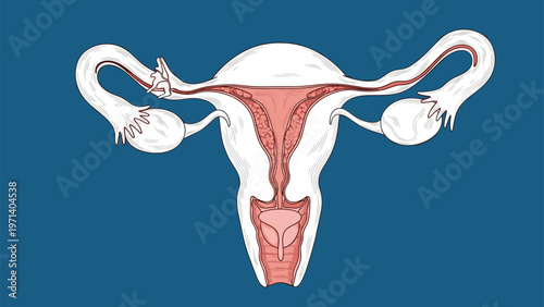 Anatomical medical illustration of the female reproductive system including the uterus, ovaries, and fallopian tubes on a blue background.