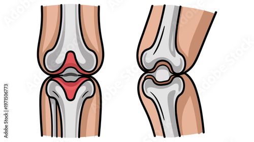 Medical illustration comparing a front and side view of a knee joint with inflamed or damaged cartilage.