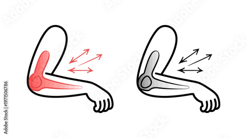 Anatomical diagrams illustrating a painful, inflamed elbow joint compared to a healthy, normal one.
