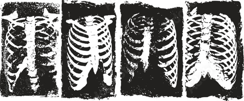 four black and white chest x rays showing rib cages and thoracic structures in medical imaging series
