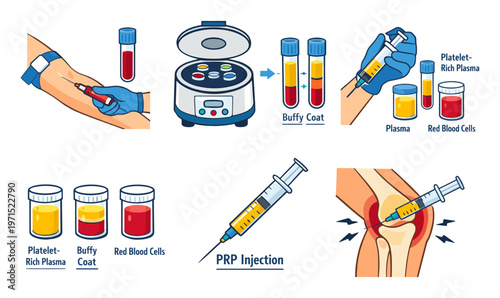 PRP therapy procedure illustration including drawing blood, centrifuging, isolating platelet-rich plasma, and performing an injection