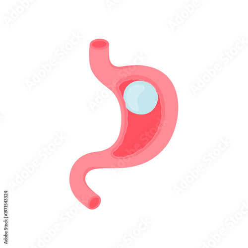Gastric balloon weight loss Illustration
