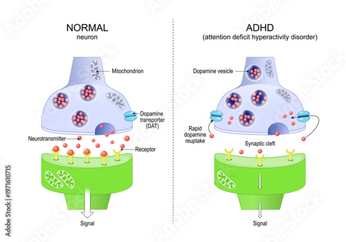 Normal neuron and ADHD neuron. Attention deficit hyperactivity disorder.