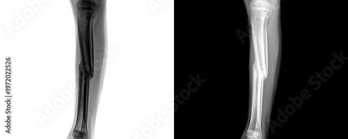 Foto Diagnostic Leg Lateral Projection X-ray Image Displaying Bone Structure and Alig